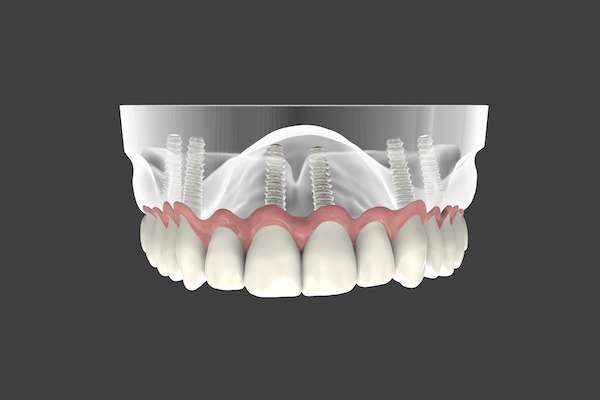 Are Implant Supported Dentures Permanent from Elite Dental & Aesthetics in Plantation, FL