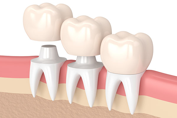 Three Tips to Deal With a Loose Dental Crown from Elite Dental & Aesthetics in Plantation, FL