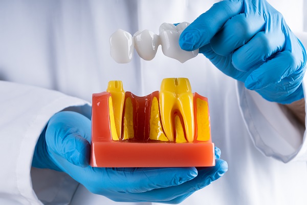 How Many Teeth Can Dental Bridges Replace?