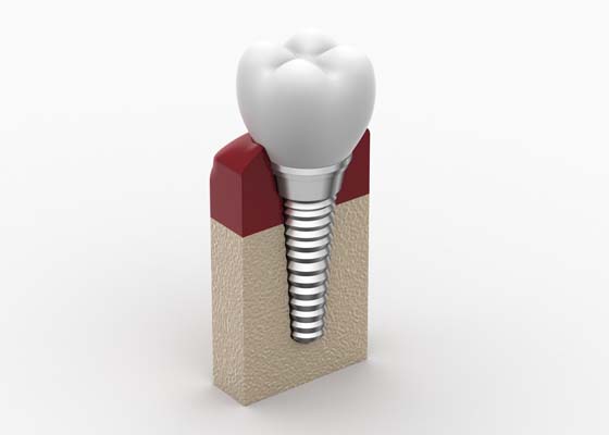 Dental Implants Plantation, FL