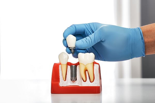 FAQs About The Process For Dental Implants