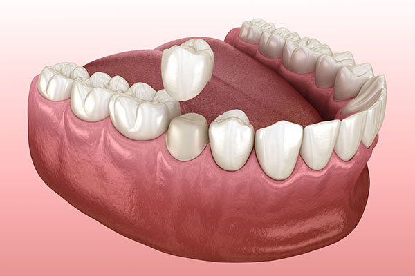 Does a Dental Crown Help After a Root Canal? from Elite Dental & Aesthetics in Plantation, FL