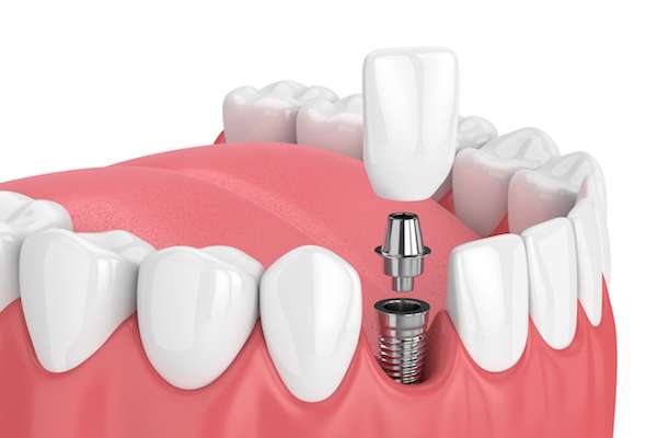 How Painful is Dental Implant Surgery from Elite Dental & Aesthetics in Plantation, FL