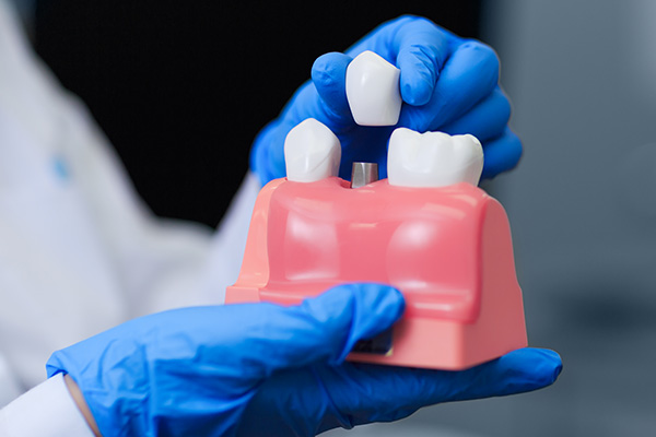 Dental Implant Options for Replacing Missing Teeth from Elite Dental & Aesthetics in Plantation, FL