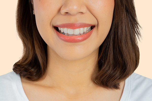 Invisalign Teeth Straightening Is More Comfortable Than Braces