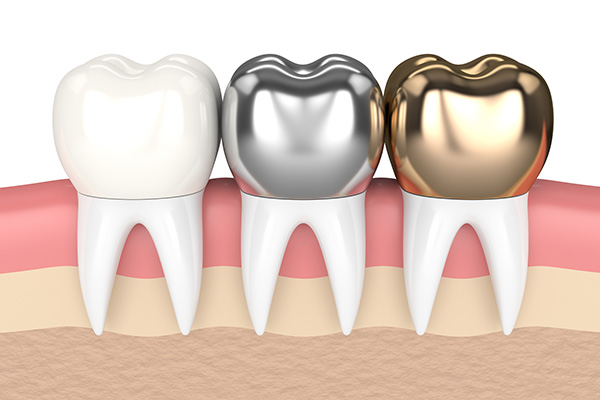 Metal Crowns vs. Porcelain Dental Crowns from Elite Dental & Aesthetics in Plantation, FL
