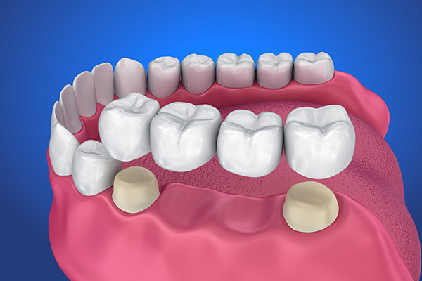 Options for Replacing Missing Teeth: The Benefits of Dental Implants from Elite Dental & Aesthetics in Plantation, FL