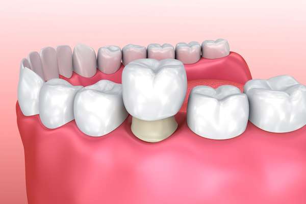 Permanent Dental Crowns vs. Temporary: Is There a Difference from Elite Dental & Aesthetics in Plantation, FL