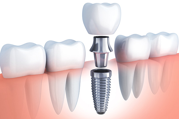 Questions to Ask Your Implant Dentist from Elite Dental & Aesthetics in Plantation, FL