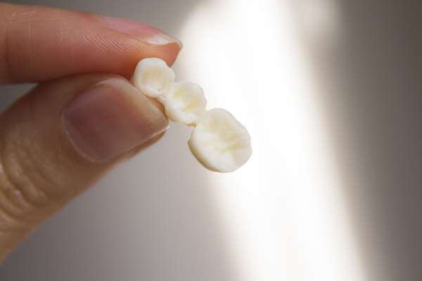 Replace Missing Teeth with Dental Bridges from Elite Dental & Aesthetics in Plantation, FL