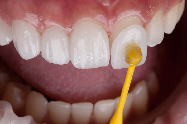 How To Prevent Stains On Dental Veneers